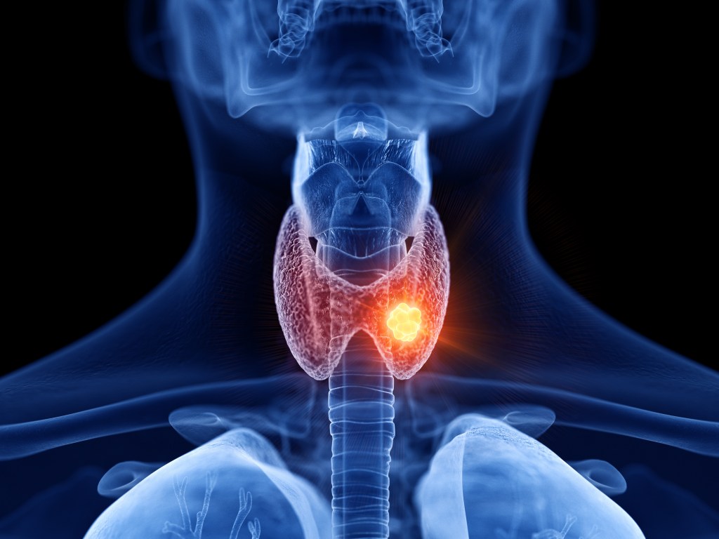 3D gave illustration of a thyroid gland affected by cancer