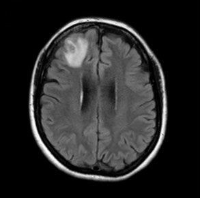 Scan of infected woman's brain