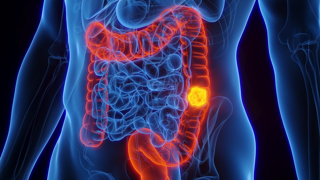Scanning of colon cancer