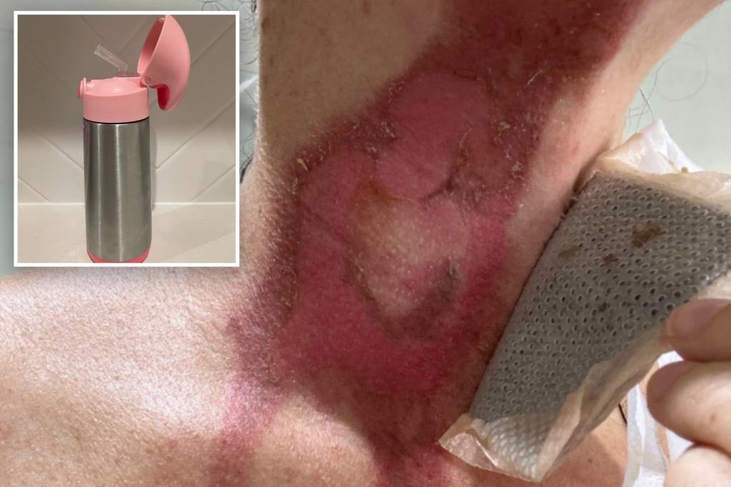 Mom releases severe warning after combustion of 'excitement' by cleaning of isolated water bottles