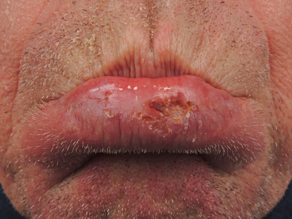 The image of a man with cancer on the lips.