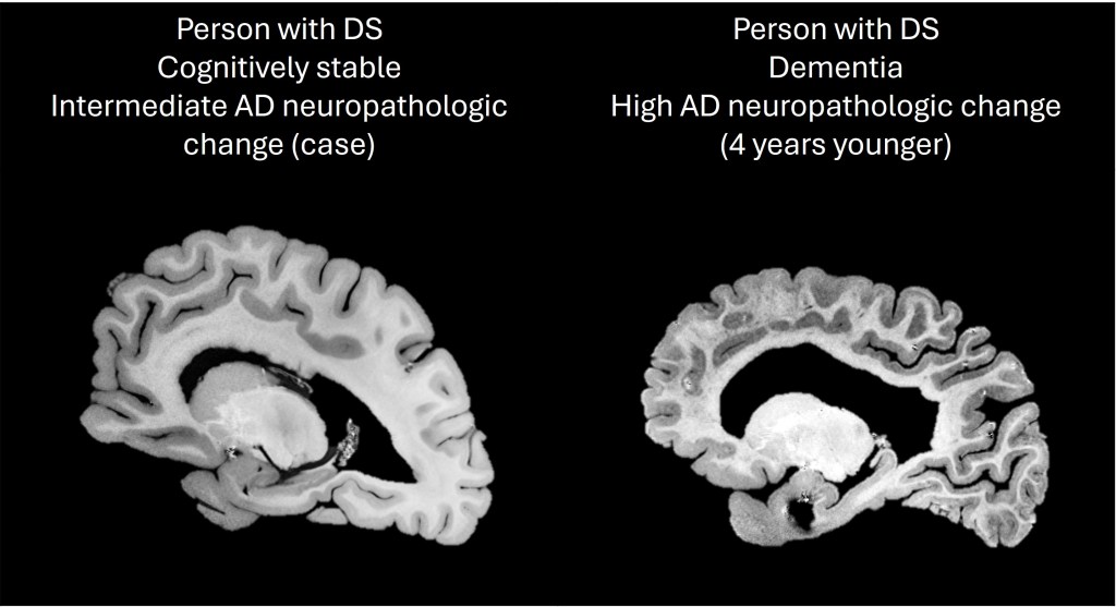 Brain comparisons of two people with Daun syndrome, with the person to the left with intermediate Alzheimer's disease and stable recognition.