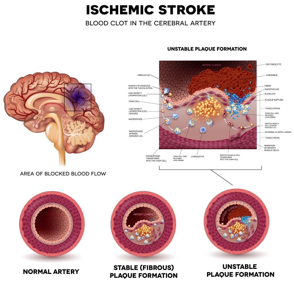 The diagram shows how the blocked causes of the blood flow causes ischemic stroke.