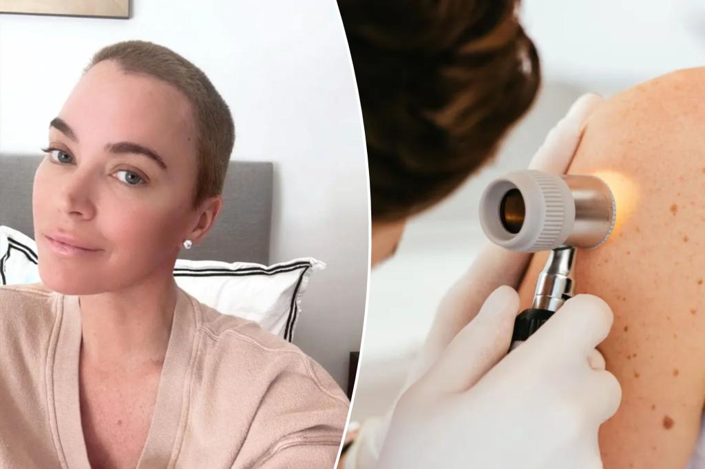 Everything about melanoma while deadly skin cancer of Teddi Melncamp has spread