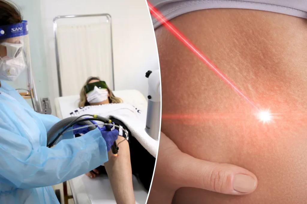 Which laser treatment is right for your skin? Experts weigh